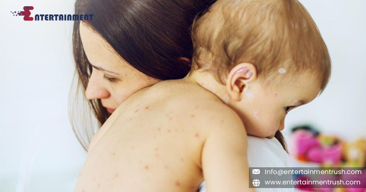 Measles Cases Surge: A Debilitating and Deadly Threat, Warn WHO and CDC